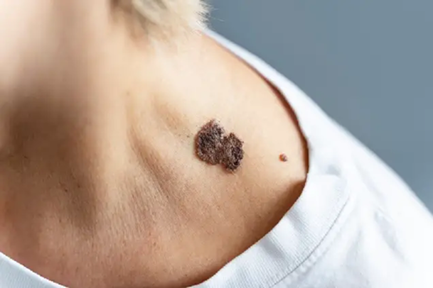 Mole Removal
