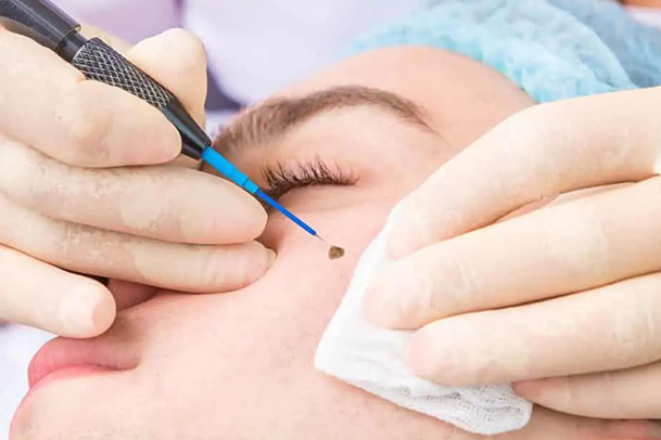 Wart Removal